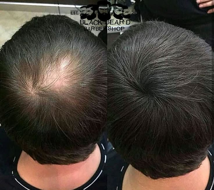 Does Dandruff Cause Hair Loss