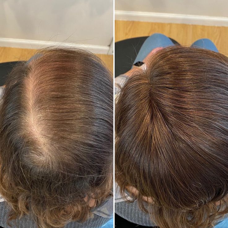 Can Dandruff Cause Hair Loss 