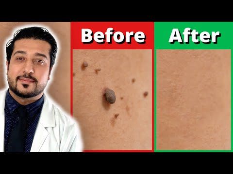 How To Remove Skin Tags At Home