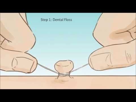 How To Remove Skin Tags At Home