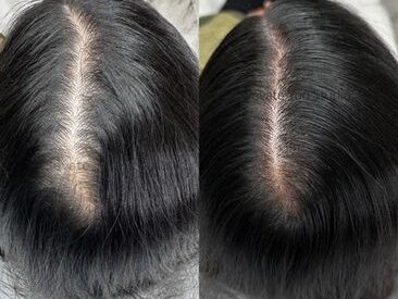 Can Dandruff Cause Hair Loss 